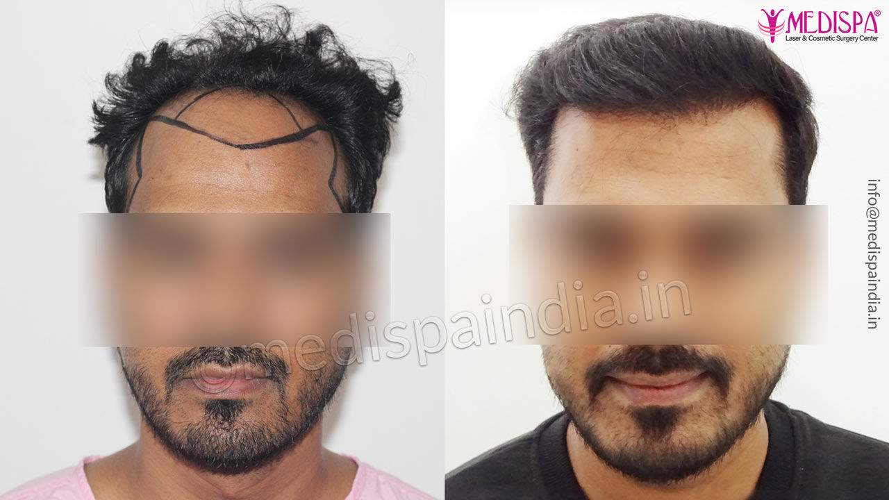 hair transplant in delhi