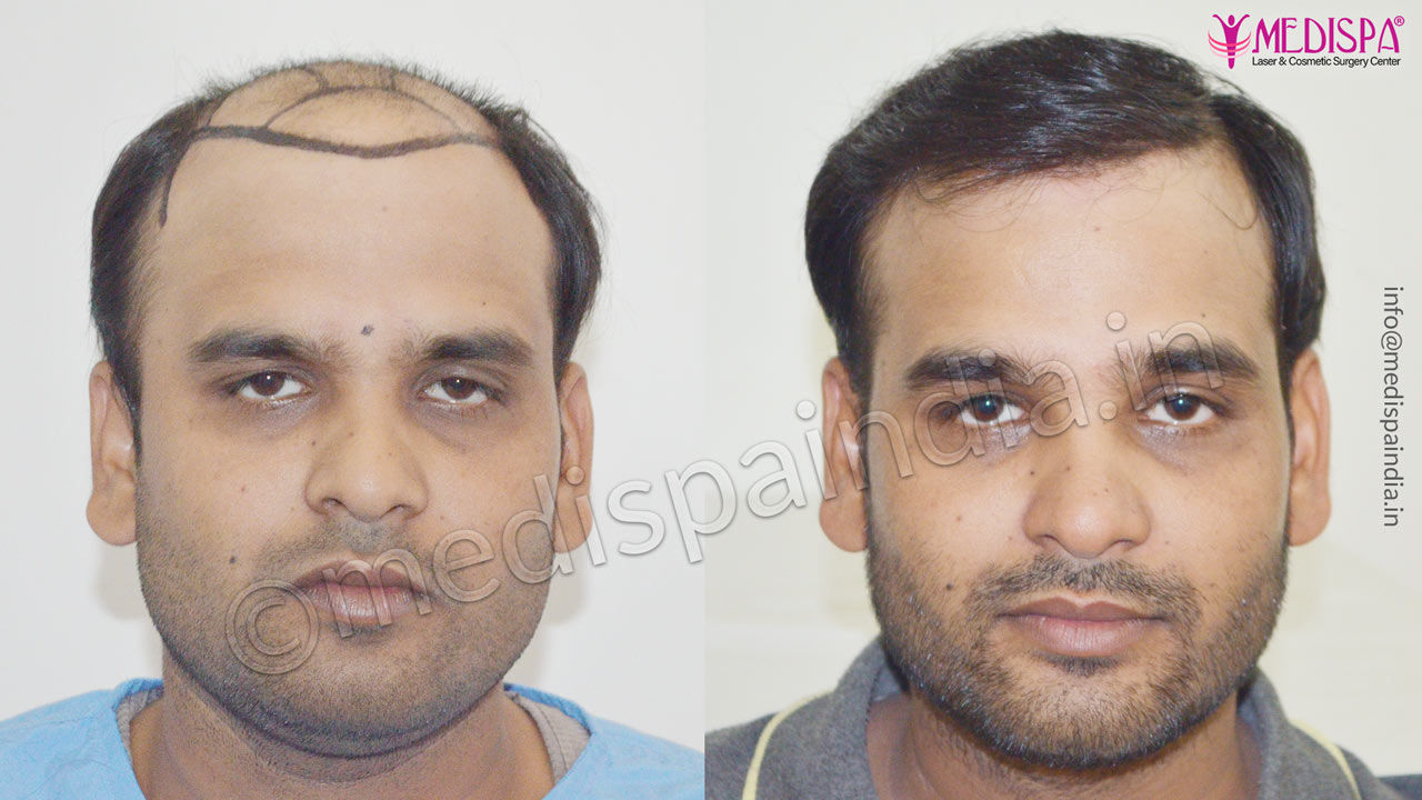 hair transplant delhi cost