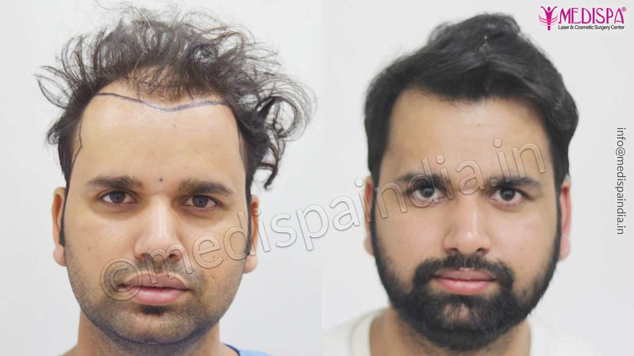 hair restoration cost india