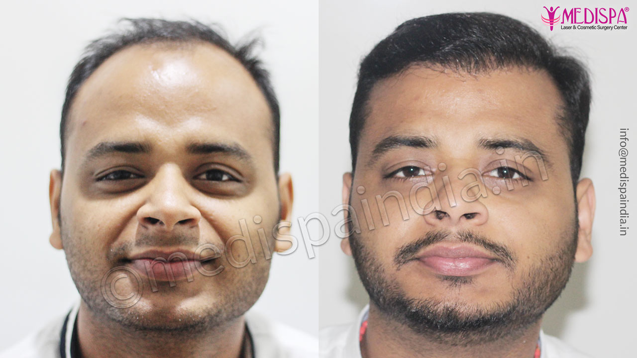 dubai hair transplant result