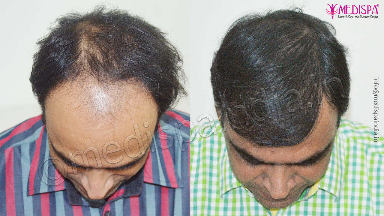 celebrity hair transplant india