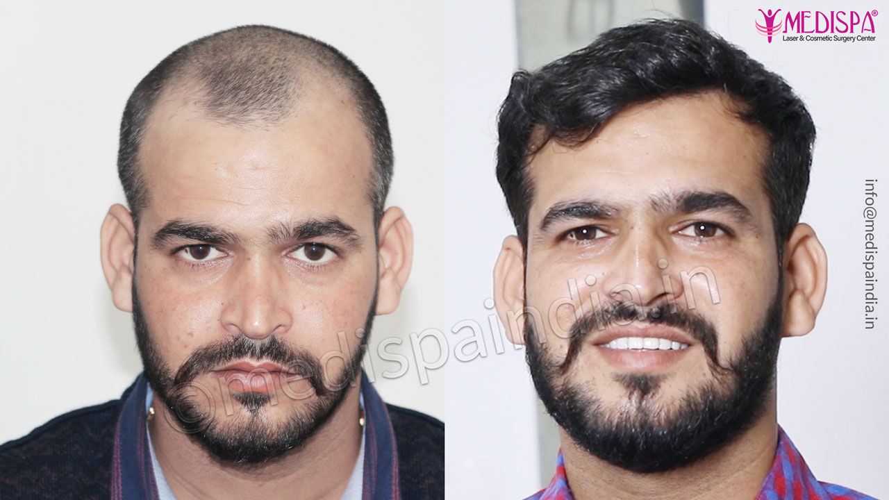 hair transplant delhi cost