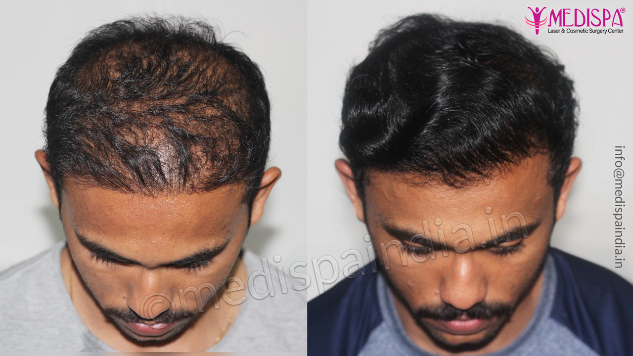 hair transplant cost in India