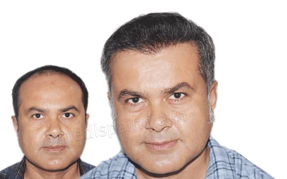 best hair transplant results in Jaipur