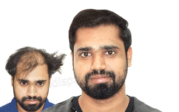 affordable hair transplant cost in india