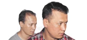 hair transplant before after result