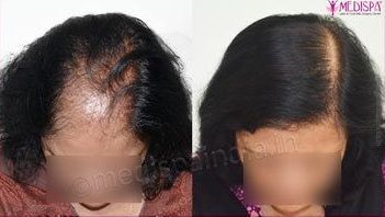 Hair Transplant in Dubai