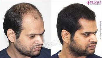 Hair Transplant in Dubai