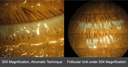 hair follicular units