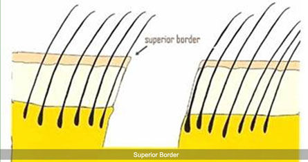 Trichophytic Closure technique