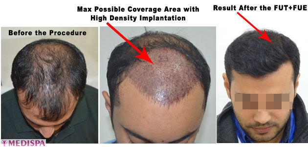 Fue And Fut Combine Hair Transplant Technique Medispa India 