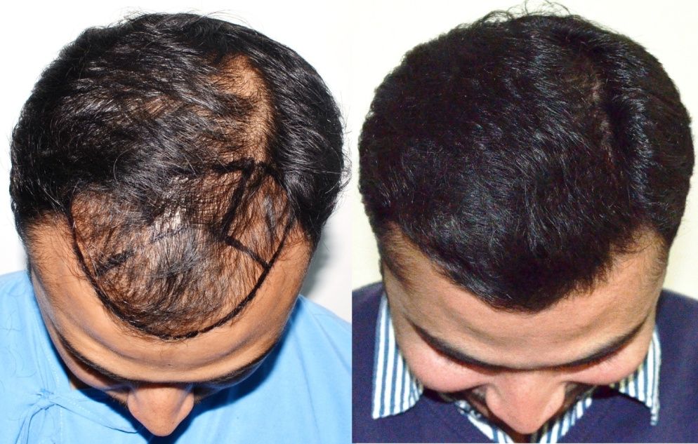 hair-transplant-results