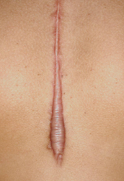 keloid
