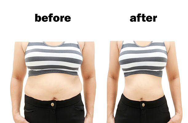 liposuction-fat-removal-surgery