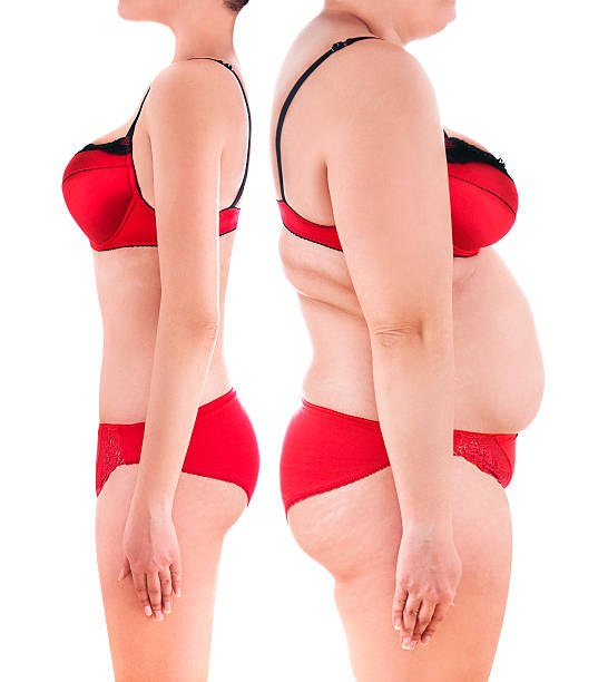 liposuction-fat-removal