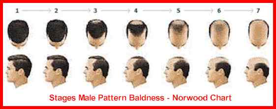 male-pattern-hair-loss