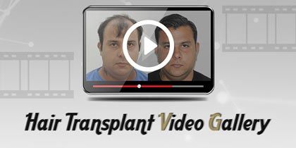 hair transplant cost