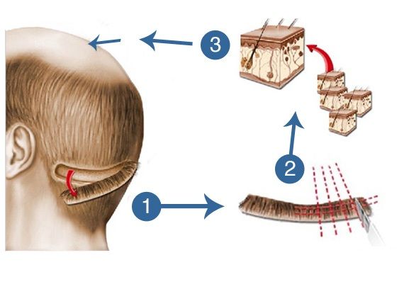 fut-hair-transplant-surgery