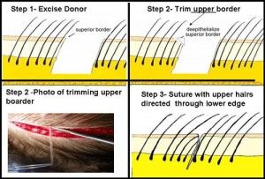 Trichophytic-Clouser-Technique