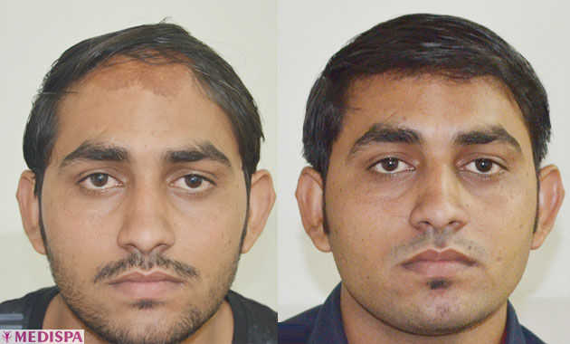 after-before-burn-hair-transplant