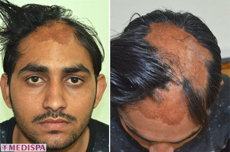 Head Quarters Hair Transplants Reviews