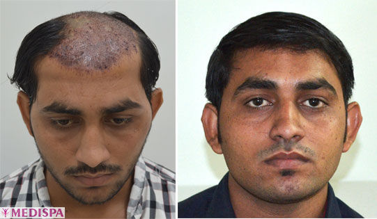 burn-hair-transplantation