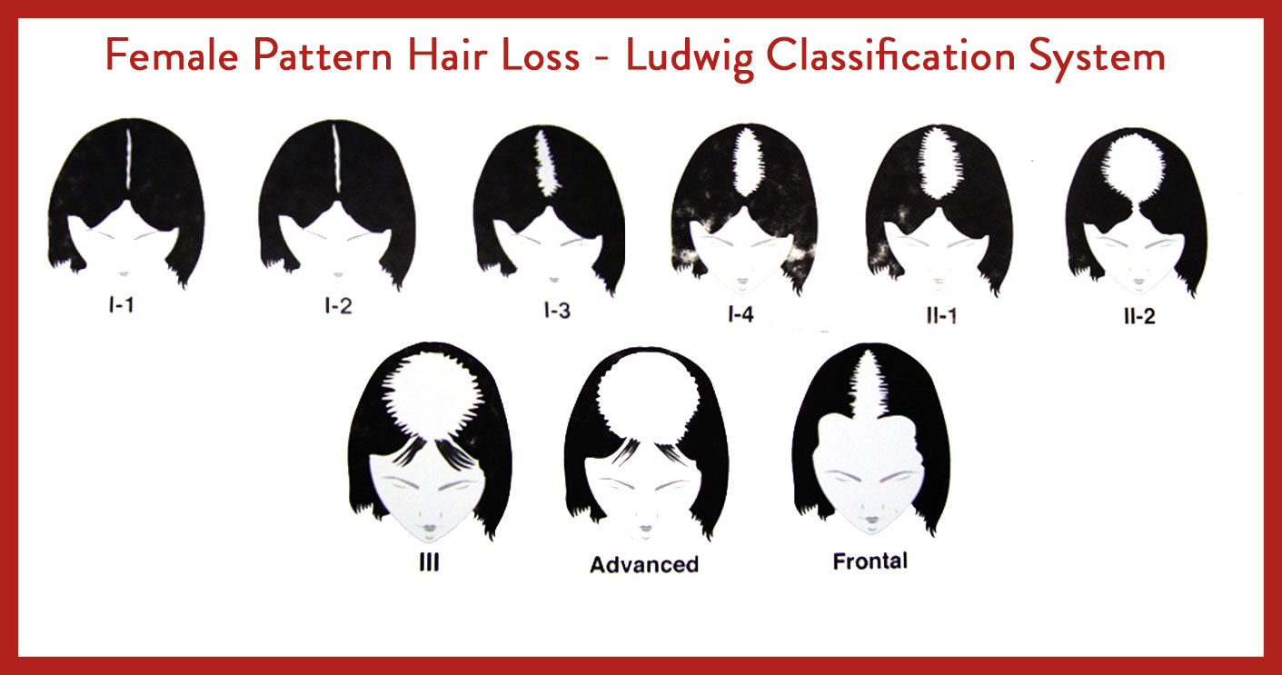 female-hair-loss-pattern-ludwig