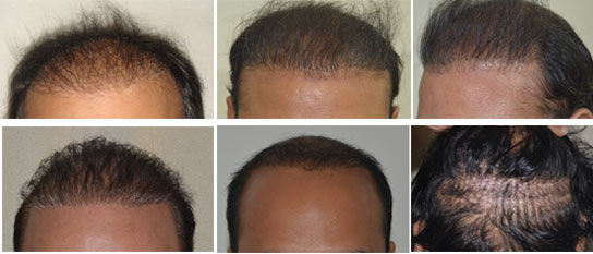 perfect hairline technique