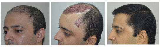 natural-hairline-hair-transplant