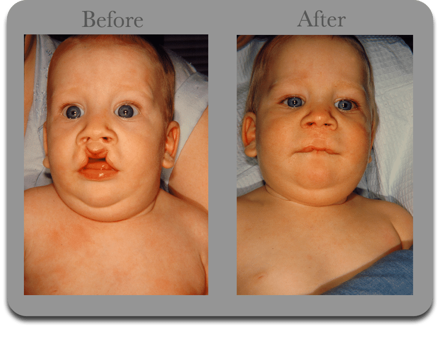 Cleft-Lip-Palate