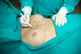 breast-reconstruction-jaipur