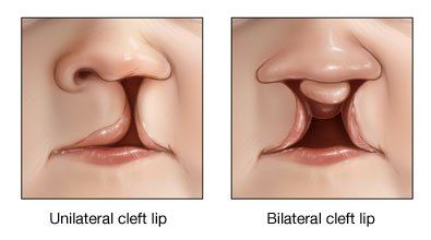 cleft_lipthu