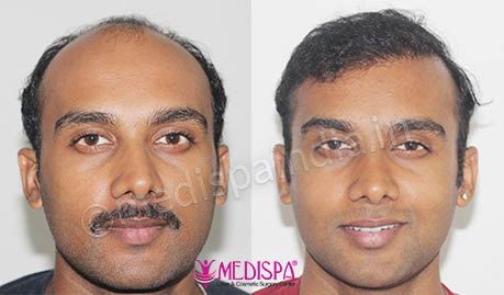 best hair transplant before after results