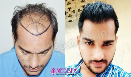 Hair Transplant in Dubai