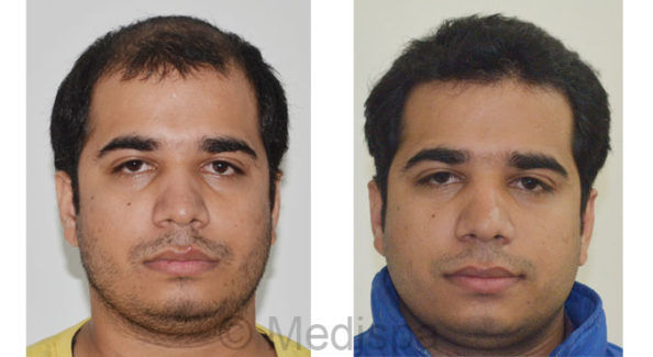 hair-transplant-cost