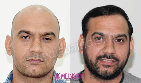 hair transplant cost in jaipur delhi india