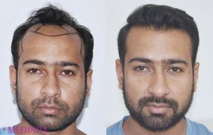 canada-hair-transplant-results