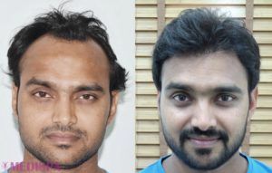 hair-transplant-australia