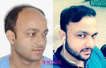 hair transplant cost in canada