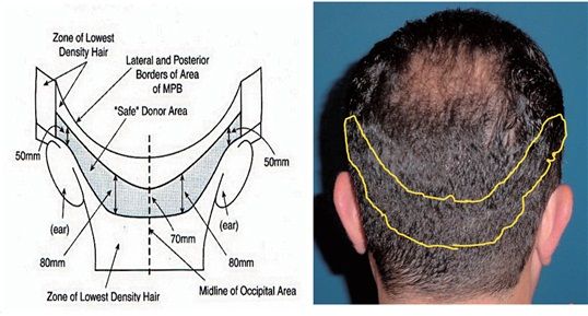 hair transplant cost