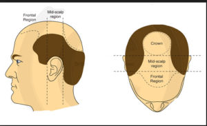 Top 10 Best Hair Transplant Clinics in Delhi NCR