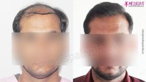 The Advantages of FUT Hair Transplant Procedure