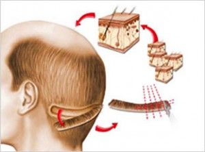 fut hair transplant