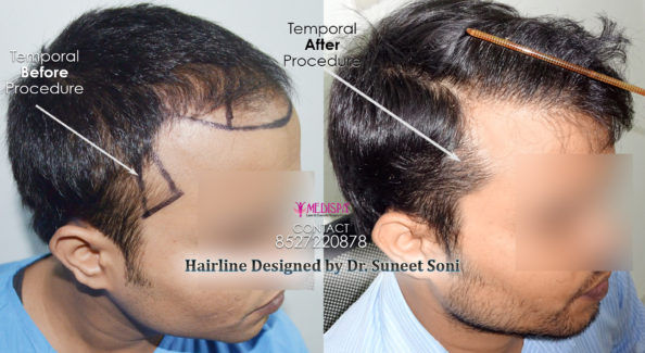 hair transplant doctors india