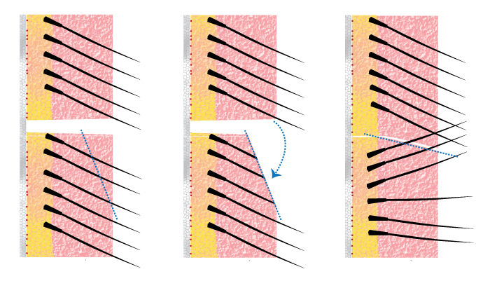 Trichophytic Closure