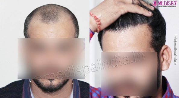 hair-transplant-results