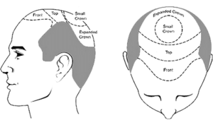 Region of the Balding Scalp (distribution of sites in the Front, Top/Vertex & Crown)