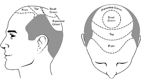 Region of the Balding Scalp (distribution of sites in the Front, Top/Vertex & Crown)