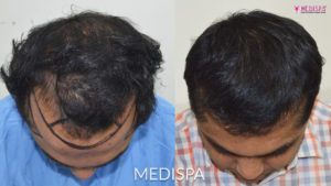 The Art of Hair Transplant Procedure