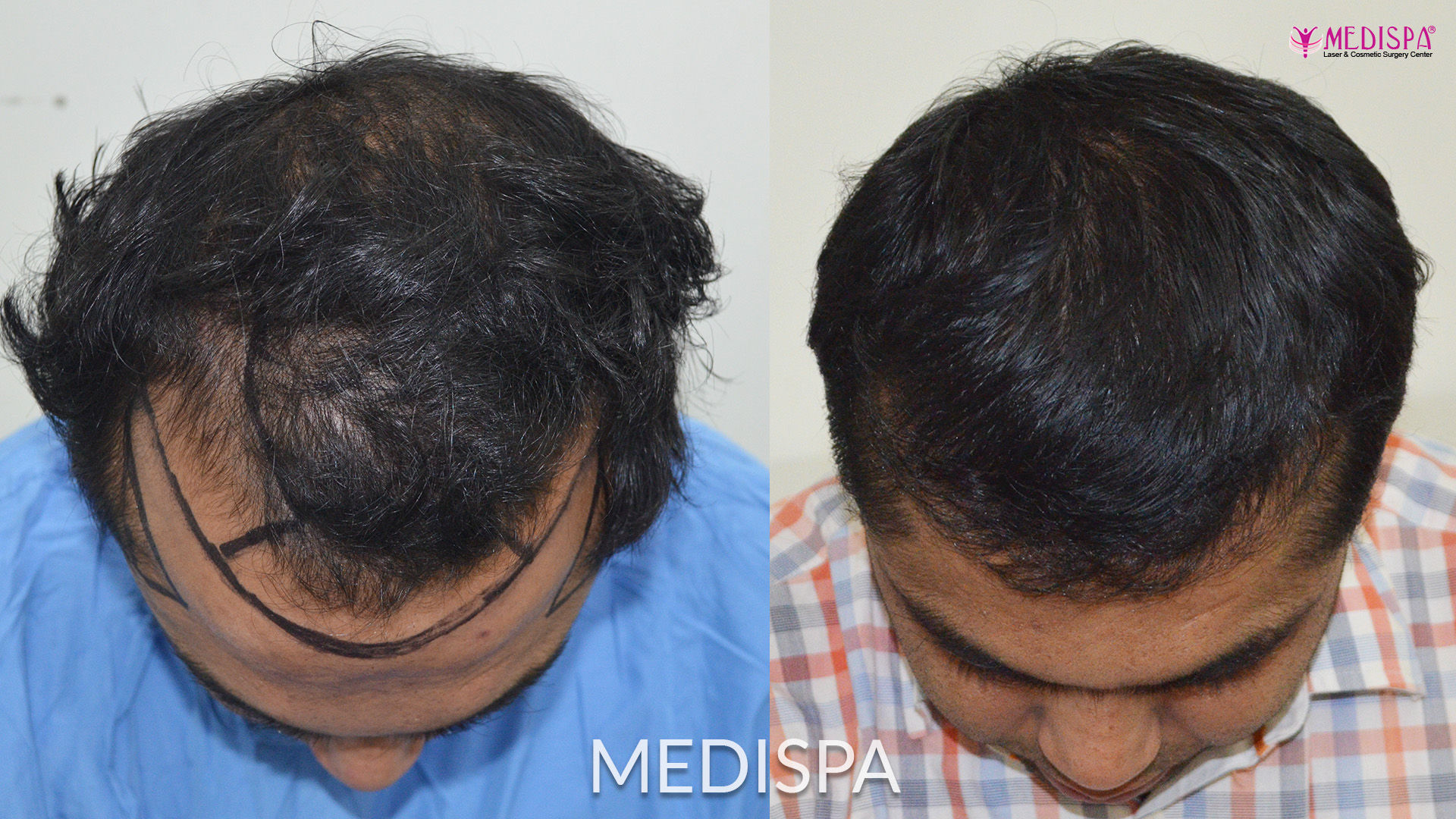 hair transplant in delhi